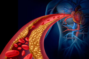 colesterol-alto-sintomas-e-o-que-deve-ser-feito-ao-identificar