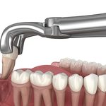 Extraction of wisdom tooth. Medically accurate tooth 3D illustra