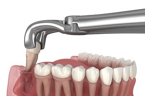 Dentes do Siso: Tudo que você precisa saber antes da extração