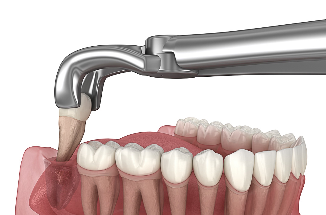 Dentes do Siso: Tudo que você precisa saber antes da extração
